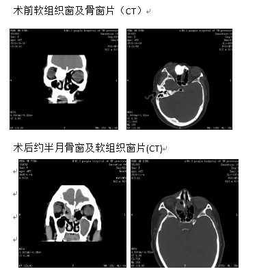 云南省第二人民医院耳鼻咽喉科成功切除额筛窦巨大骨瘤累及前颅底及